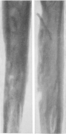 Рис. 255. Кокцидиоидоз костей у 20-летней больной. Обширный гнойно-воспалительный свищевой процесс, захватывающий весь диафиз правой плечевой кости, со множественными секвестральными полостями и секвестрами. В гною обнаружены сферулы кокцидиоидоза.