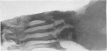 Рис. 258. Мадурская болезнь — мицетома стопы у женщины 31 года с типичной клинической, рентгенологической и микологической картиной. Из свищей, периодически открывавшихся, выделялись желтые зерна.