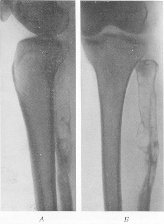 Рис. 259. Эхинококк малоберцовой кости (распознан правильно лишь во время оперативного вмешательства). А — задняя рентгенограмма; Б — боковая рентгенограмма.
