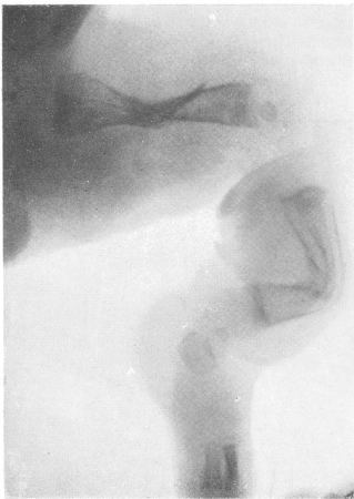 Рис. 263. Несовершенный остеогенез. Новорожденная девочка. Деталь рентгенограммы левой ножки. Перелом бедра и костей голени со значительным смещением отломков.