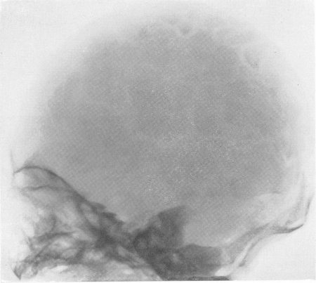 Рис. 264. Несовершенный остеогенез. Типичная рентгенологическая картина черепа. 
