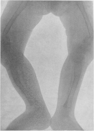 Рис. 265. Рентгенограмма нижних конечностей при несовершенном костеобразовании у грудного ребенка с ограниченным числом переломов бедер и костей голени.