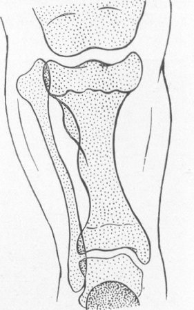 Рис. 269. Схематическое изображение рентгенограммы области коленного сустава и голени при хондродистрофии. Высокое стояние головки малоберцовой кости.
