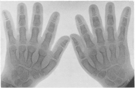 Рис. 270. Типичная рентгенологическая картина кистей при хондродистрофии у 10-летней девочки.