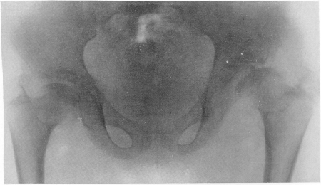 Рис. 277. Та же больная. Рентгенограмма таза. Типичные изменения бедренных головок, напоминающие остеохондропатию.