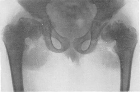 Рис. 278. Та же больная. Рентгенограмма области таза. Картина, внешне напоминающая двустороннюю остеохондропатию.