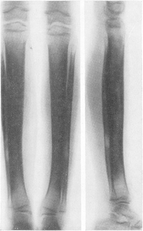 Рис. 288. Врожденные системные диафизарные гиперостозы у 11-летней девочки. Рентгенограмма обеих голеней. А — прямая рентгенограмма; Б — боковая рентгенограмма.