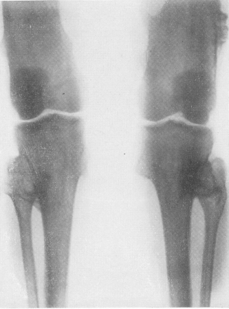 Рис. 293. Множественные хрящевые экзостозы у 25-летнего физкультурника, направленного на рентгенологическое исследование по поводу травматического вывиха левого плеча.