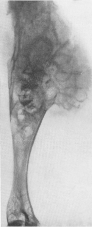 Множественный хондроматоз костей (болезнь Олье). Озлокачествление одного из костно-хрящевых узлов в области диафиза плечевой кости