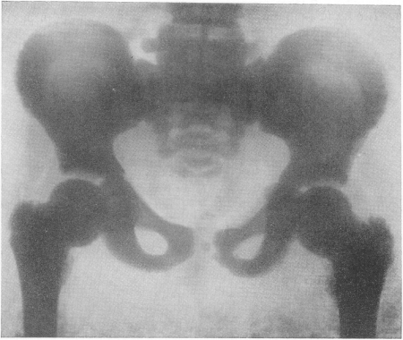 Рис. 305. Врожденная мраморная болезнь у 10-летнего мальчика. В анамнезе — несколько переломов костей, патологический характер которых был просмотрен вследствие неприменения рентгенологического исследования. Нормальная картина крови. Нормальные биохимические показатели. Рентгенограмма таза.
