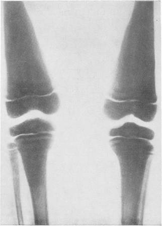 Рис. 306. Тот же больной. Рентгенограмма нижней половины бедер и верхней половины берцовых костей, а также коленных суставов.