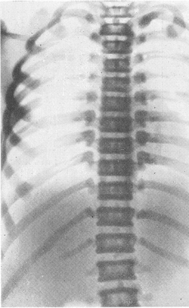 Рис. 309. Тот же больной. Задняя (А) и боковая (Б) рентгенограммы грудного отдела позвоночника. Резко выраженная полосатость (стратификация).  