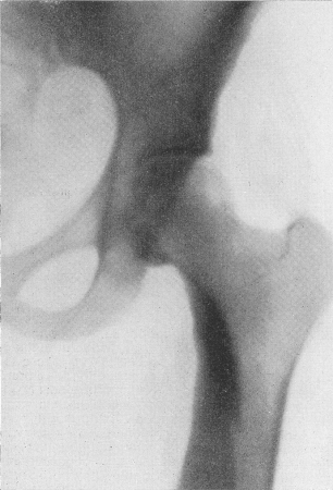 Рис. 315. Мелореостоз Лери. 28-летняя женщина. Рентгенограмма области левого тазобедренного сустава в связи с небольшими глухими болями в этой области. Типичная рентгенологическая картина, изменения нарастают по направлению к дистальному концу левой нижней конечности.