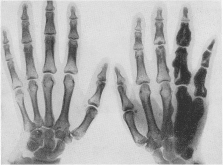 Рис. 316. Мелореостоз Лери у 29-летнего больного. Типичное поражение 2,1/2 пальцев левой кисти, по ульнарному краю. Девиация IV и особенно V пальца в ульнарную сторону.