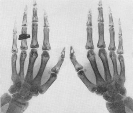 Рис. 318. Типичная картина остеопойкилии у 37-летней женщины. Рентгенограмма обеих кистей.