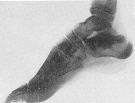 Рис. 319. Остеопойкилия у 12-летней девочки. Рентгенограмма стопы. Крупноочаговая форма.
