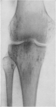 Рис. 320. Типичная картина остеопойкилии у 46-летнего мужчины. Рентгенограмма области коленного сустава.