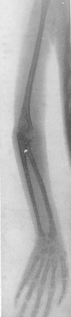 Рис. 321. Арахнодактилия. Рентгенограмма верхней конечности у 4-летней девочки с резко выраженной клинико-рентгенологической картиной.