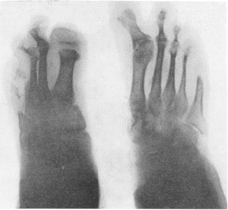 Рис. 326. Акростеолиз у той же больной. Рентгенограмма обеих стоп. „Подвешенные в мягких тканях” костные остатки основных фаланг большого пальца и ряда фаланг IV и V пальцев слева.