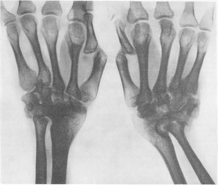 Рис. 327. Акроостеолиз у 40-летнего мужчины. Остеолиз костей запястья. Вывих основных фаланг большого пальца с обеих сторон. Нервная система в норме, никаких изменений чувствительной сферы.