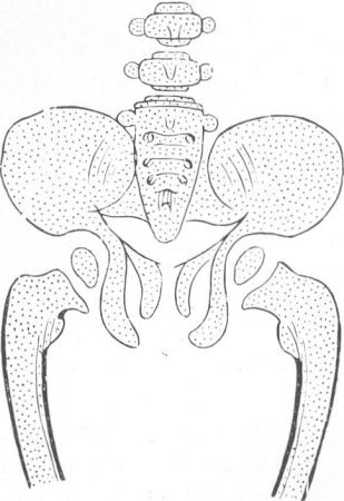 Рис. 332. Схематическое изображение деформаций двустороннего coxa vara rachiti.