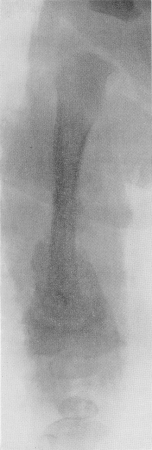 Детская цинга. Прямая рентгенограмма бедра мальчика с крайнего Севера в возрасте 1 года. Типичная картина интраметафизарного патологического    перелома в дистальном конце. Обширное метафизарное поднадкостничное кровоизлияние с оссифицирующим периостозом.