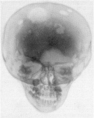 Рис. 340. Костный ксантоматоз у мальчика в возрасте 4 лет 8 месяцев. В клинической картине — асимметричное пучеглазие, полидипсия, полиурия. Типичная рентгенологическая картина черепа (прямая рентгенограмма). Гистологическое подтверждение диагноза.