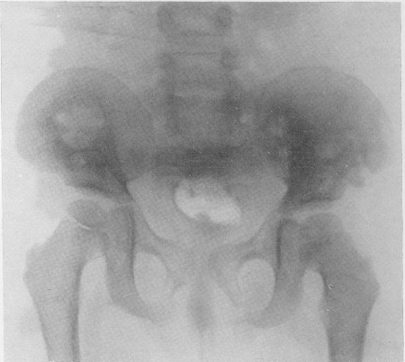 Рис. 342. Костный ксантоматоз у 5-летней девочки. Обширные поражения тазовых костей, преимущественно подвздошных костей асимметрического характера. Гистологическое подтверждение диагноза.