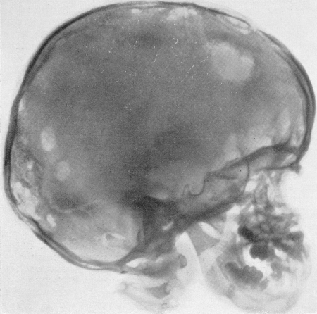 Рис. 341. Боковая рентгенограмма черепа того же ребенка.