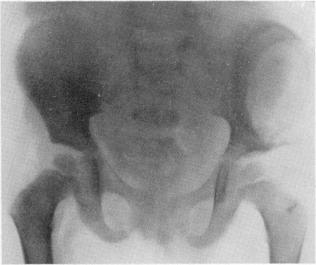 Рис. 343. Костный ксантоматоз у мальчика 3 лет 6 месяцев. Крупный очаг разрушения левой подвздошной кости. Гистологическое подтверждение диагноза.