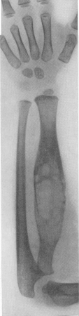 Рис. 344. То же наблюдение. Ксантоматозный узел в диафизе лучевой кости.