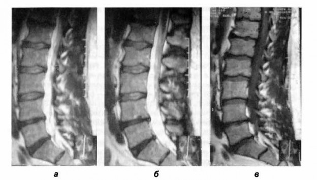 Увеличение высоты межпозвонковых дисков