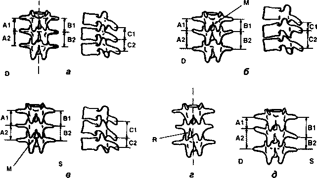 Рис. 14. Схематичное изображение рентгенологических признаков межпозвонковых дисфункций: а — норма (расстояния между поперечными отростками А1=В1, А2=В2; расстояние между остистыми отростками С1=С2); б— флексия позвонка (А1<А2, В1<В2, С1<С2); в — экстензия позвонка (А1>А2, В1>В2, С1>С2); г — ротация позвонка (линейное смещение остистого отростка): д — латерофлексия позвонка влево (А1<А2, В1>В2)