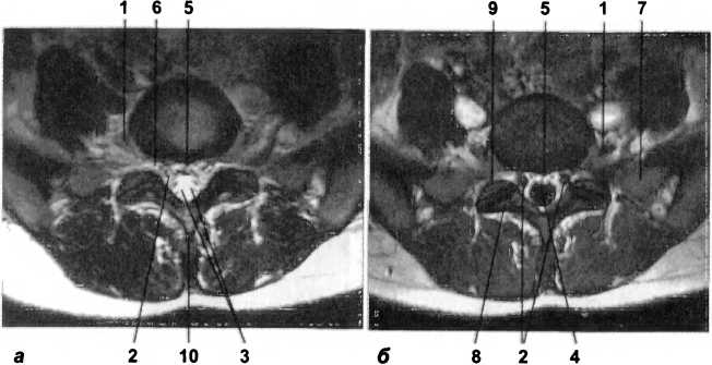 Рис. 17. МРТ в аксиальной плоскости на уровне LV-S|. На Т1- (а) и Т2-ВИ (б) визуализируются: 1 — спинномозговой нерв Lv; 2 — корешки спинномозговых нервов; 3 — корешки крестцовых и копчиковых спинномозговых нервов; 4 — субарахноидальное пространство; 5 — эпидуральная клетчатка; 6 — межпозвоночное отверстие; 7 — боковая масса крестца; 8 — нижний суставной отросток Lv; 9 — верхний суставной отросток S|; 10 — остистый отросток Lv