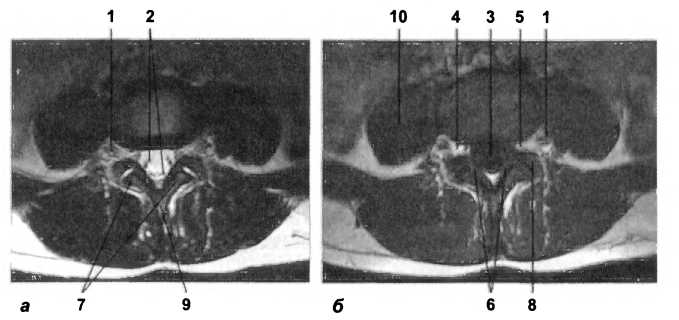 Рис. 18. МРТ в аксиальной плоскости на уровне LIV-Lv. На Т1- (а) и Т2-ВИ (б) визуализируются: 1 — спинномозговой нерв LIV; 2 — корешки спинномозговых нервов; 3 — субарахноидальное пространство; 4 — эпидуральная клетчатка; 5 — межпозвоночное отверстие; 6 — желтые связки; 7 — нижний суставной отросток LIV; 8 — верхний суставной отросток Lv; 9 — остистый отросток LIV; 10 — поясничная мышца
