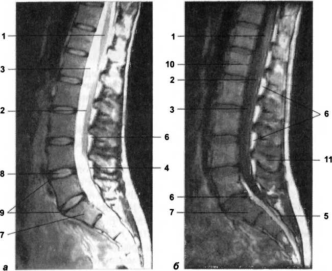 Рис. 19. Сагиттальные МР-томограммы пояснично-крестцового отдела позвоночника. На Т1- (а) и Т2-ВИ (б) визуализируются: 1 — конус спинного мозга; 2 — конский хвост спинного мозга; 3 — субарахноидальное пространство; 4 — дуральный мешок; 5 — терминальная нить, 6 — эпидуральное пространство; 7 — тело SI; 8 — пульпозное ядро межпозвоночного диска; 9 — фиброзное кольцо межпозвоночного диска; 10 — каналы базивертебральных вен; 11 — остистый отросток LIV
