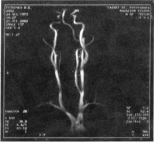 Рис. 21. Магнитно-резонансная ангиография: гипоплазия правой позвоночной артерии; патологическая извитость обеих внутренних сонных артерий