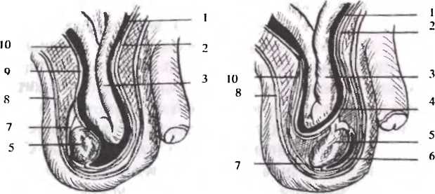 Рис. 11. Врожденная (слева) и приобретенная (справа) косая паховая грыжа (схема): 1 - брюшина: 2 - поперечная фасция: 3 - тонкая кишка; 4 - грыжевой мешок: 5 - яичко: 6 - влагалищная оболочка яичка; 7 - мясистая оболочка: 8 - кожа: 9 - грыжевой мешок (влагалищная оболочка яичка); 10 - внутренняя фасция семявыносящего протока