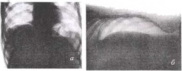 Рис. 33. Рентгенограммы при пневмоперитонеуме: а - газ пол правым куполом диафрагмы (положение больного стоя); б - газ между краем реберной дуги и печенью (положение больного лежа)