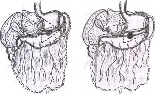 Рис. 40. Объем удаляемых тканей при раке желудка: а - субтотальная резекция желудка: б - гастрэктомия