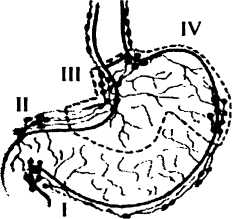 Рис. 41. Схема субтотальной проксимальной резекции желудка при раке: I-IV - лимфатические барьеры желудка