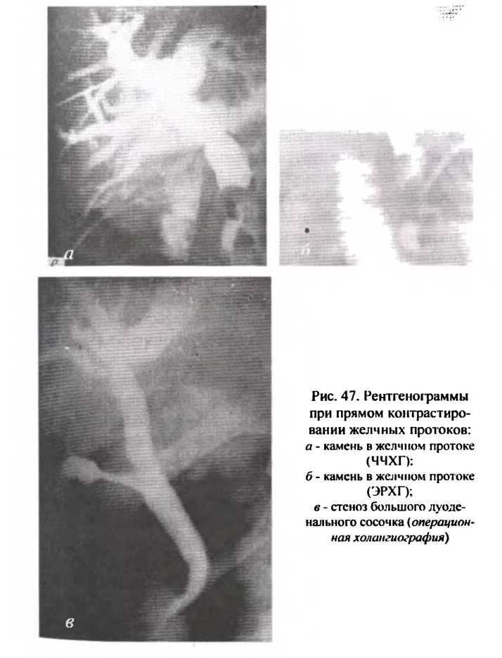 Рентгенограммы при прямом контрастировании желчных протоков