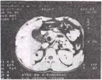 Рис. 53. Компьютерная томограмма при калькулезном панкреатите (стрелка указывает на обызвествленный участок железы)