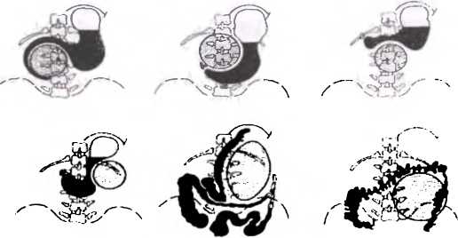 Рис. 58. Схема взаимоотношения кист поджелудочной железы с органами желудочно-кишечного тракта при рентгенологическом исследовании