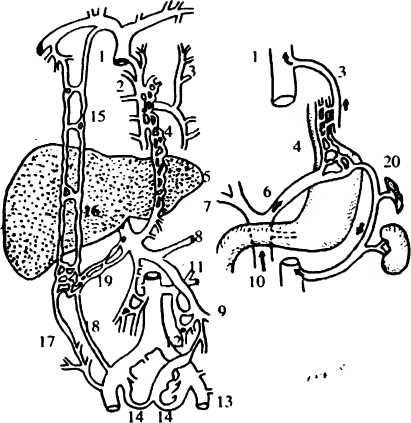 Схема анастомозов воротной вены при циррозе печени