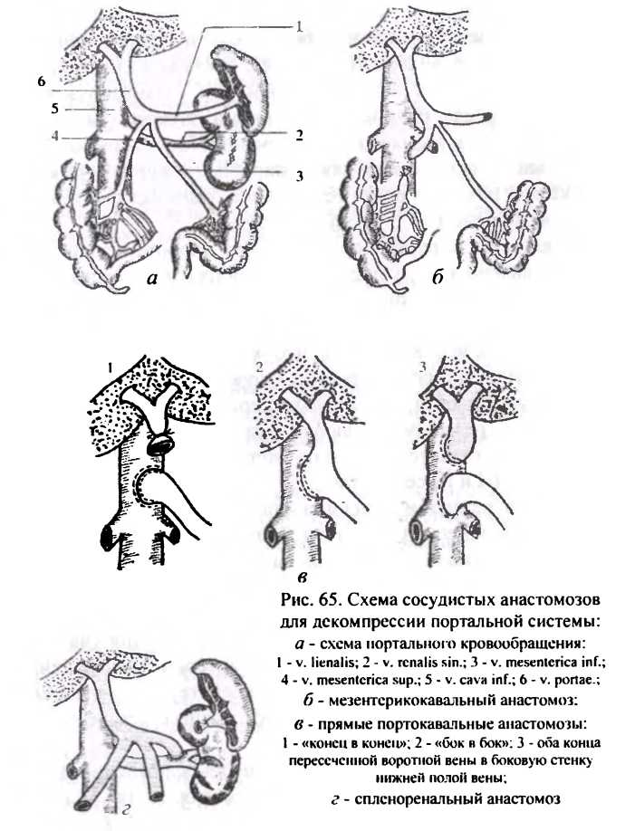 Схема сосудистых анатомозов для декомпрессии портальной системы
