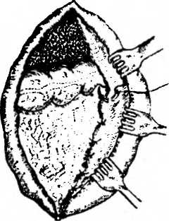 Рис. 66. Операция Talma при циррозе печени (подшивание сальника к передней брюшной стенке)