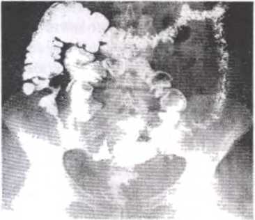 Рис. 67. Рентгенологическая картина терминального илеита Суженный участок дисгаиьного отдела подвздошной кишки имеет неправильные контуры