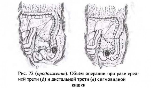 Схема изменений толстой кишки при болезни гиршпрунга